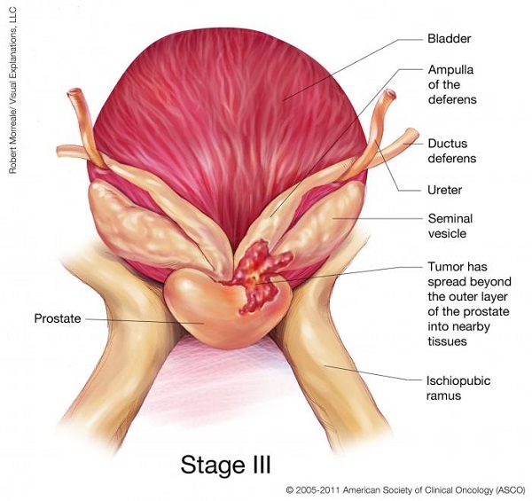 Ung thư tuyến tiền liệt giai đoạn 3 có chữa khỏi không?
