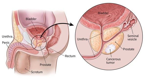 Ung thư tuyến tiền liệt giai đoạn đầu sống được bao lâu?