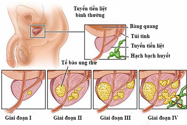 Ung thư tuyến tiền liệt giai đoạn III sống được bao lâu?