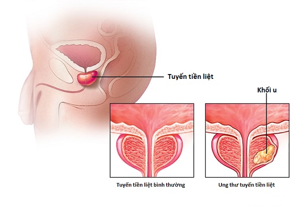 Ung thư tuyến tiền liệt: Những điều bạn cần biết