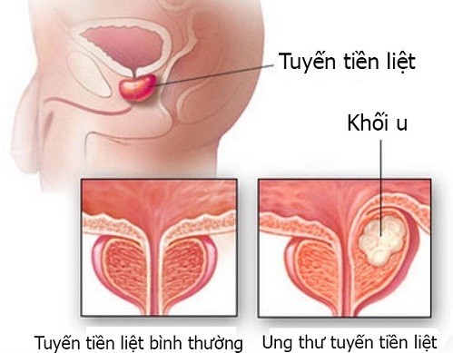 Ung thư tuyến tiền liệt và những điều cần biết