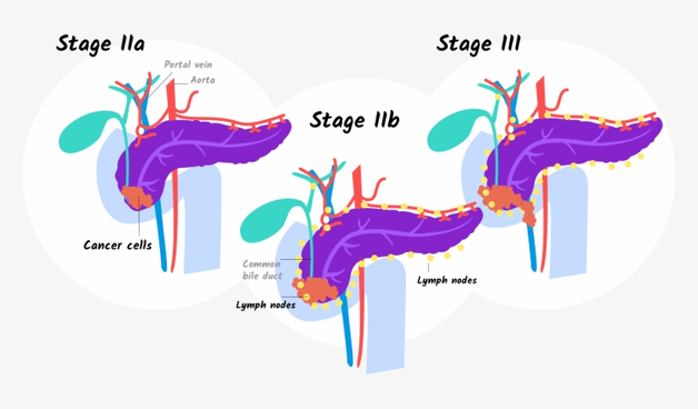 Ung thư tuyến tụy giai đoạn 3 và cách điều trị