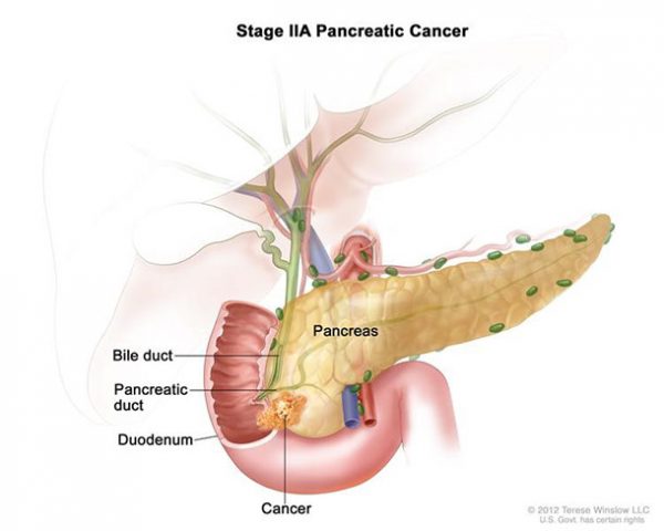 Ung thư tuyến tụy giai đoạn II sống được bao lâu?