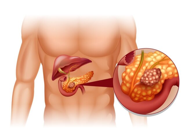 Ung thư tuyến tụy: Triệu chứng và nguyên nhân