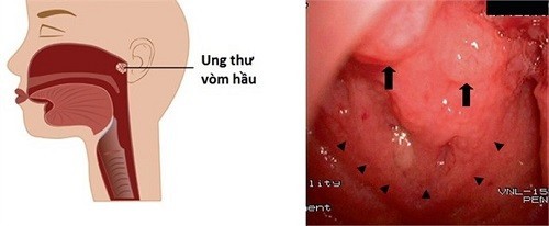 Ung thư vòm họng thường gặp ở độ tuổi nào?