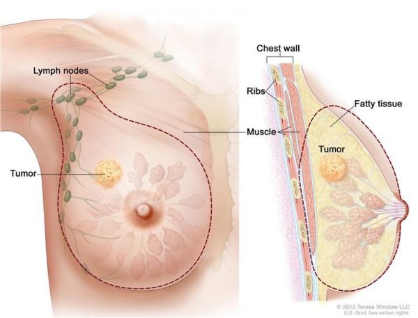 Ung thư vú có chữa được không, các phương pháp điều trị