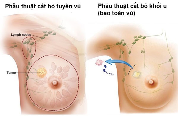 Ung thư vú: Nên cắt bỏ hay bảo toàn vú?