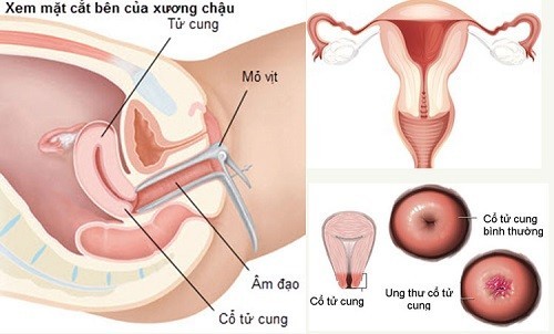 Ưu đãi cực lớn: Sàng lọc sớm ung thư cổ tử cung