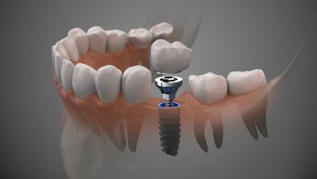 Ưu & nhược điểm của phương pháp trồng răng sứ implant