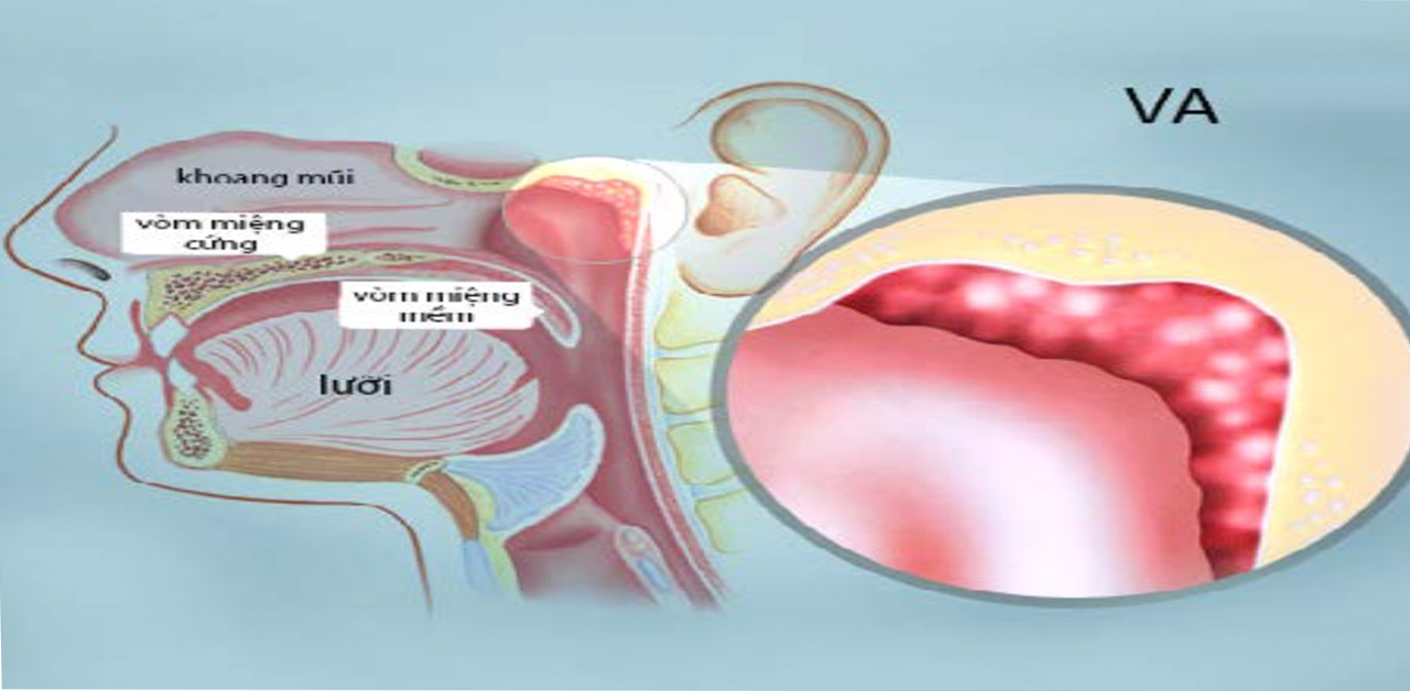 VA là bệnh gì? điều trị bệnh thế nào hiệu quả