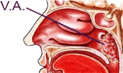 VA là bệnh gì? điều trị bệnh thế nào hiệu quả