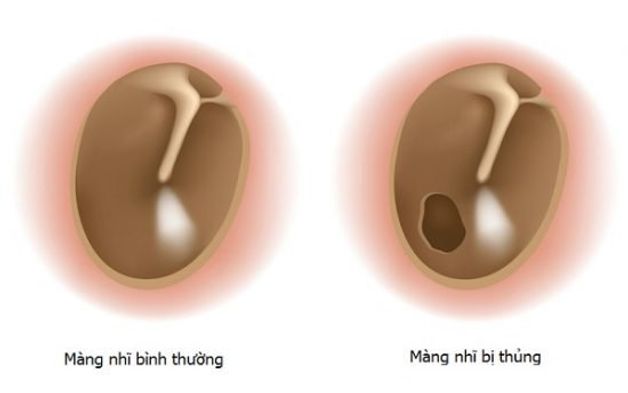 Vá màng nhĩ có hồi phục chức năng nghe không?