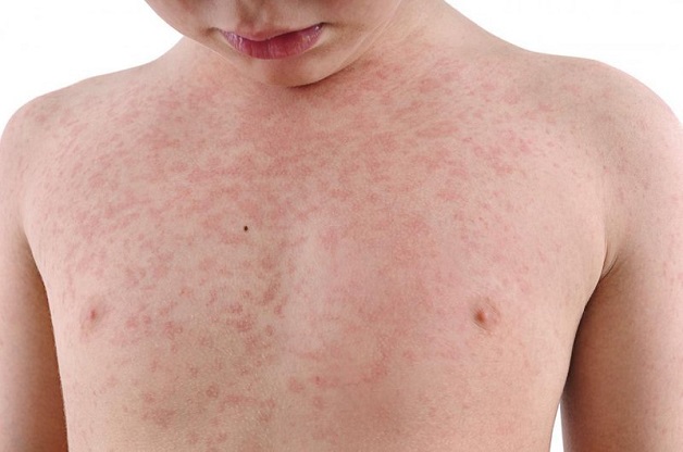 Vắc xin Rubella và những thông tin về bệnh nguy hiểm cần tránh