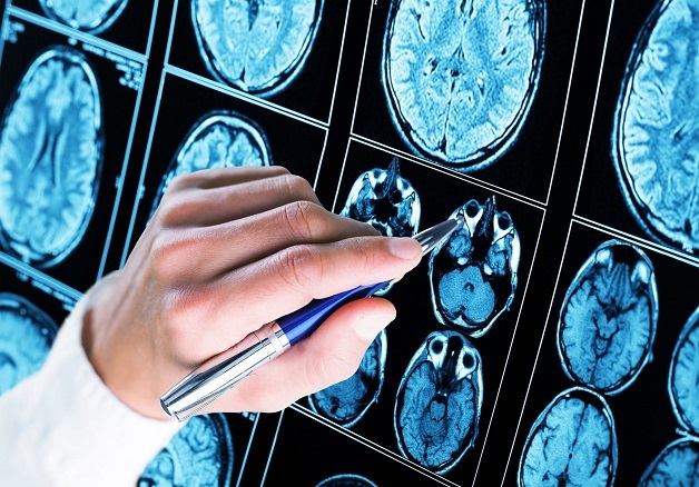 Vai trò chụp MRI trong chẩn đoán đột quỵ nhồi máu não diện rộng