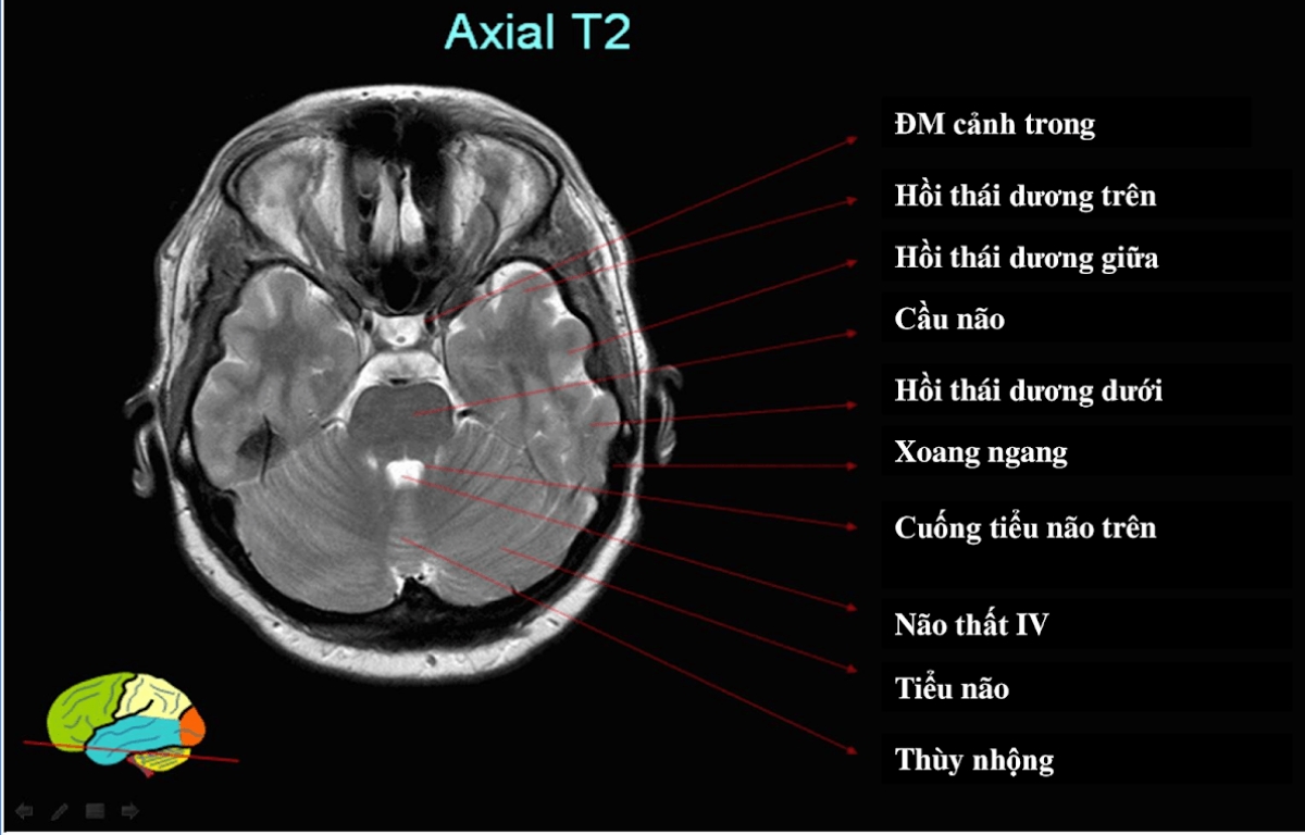 Vai trò của chụp MRI sọ não trong chẩn đoán và điều trị bệnh hệ thần kinh