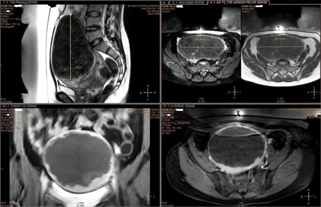 Vai trò của chụp MRI tiểu khung trong tầm soát ung thư