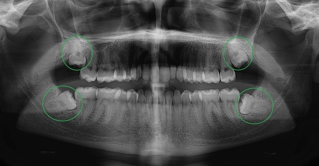 Vai trò của kỹ thuật chụp X quang răng khôn