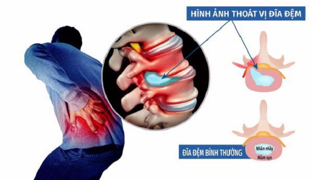 Vấn đề đi bộ ở người bị thoát vị đĩa đệm