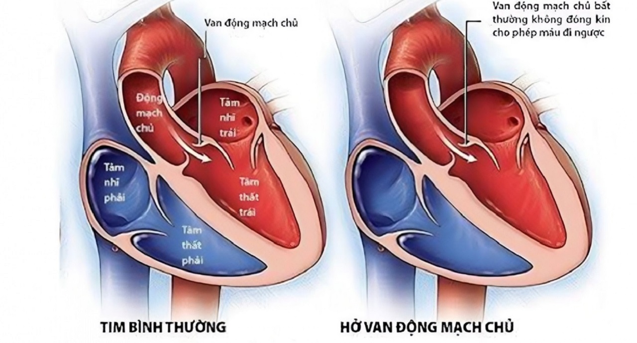 Van động mạch chủ: Cấu trúc, chức năng và bệnh lý