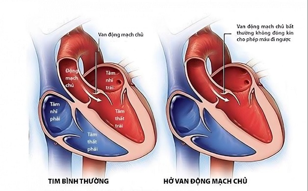 Van động mạch chủ: Cấu trúc, chức năng và bệnh lý