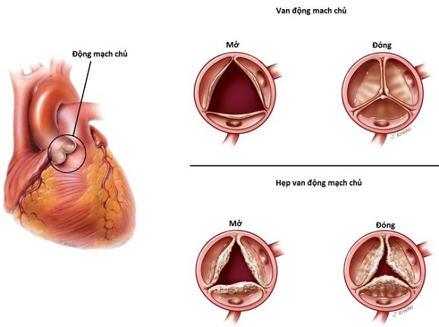 Van động mạch chủ và những bệnh lý thường gặp 