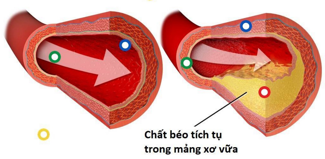 “Vén màn” chứng xơ cứng động mạch vành 