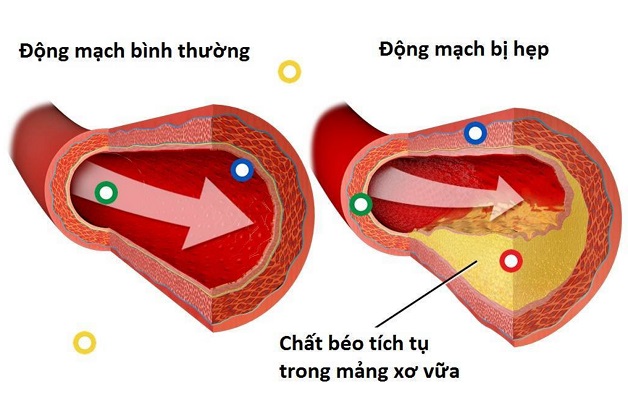 “Vén màn” chứng xơ cứng động mạch vành 