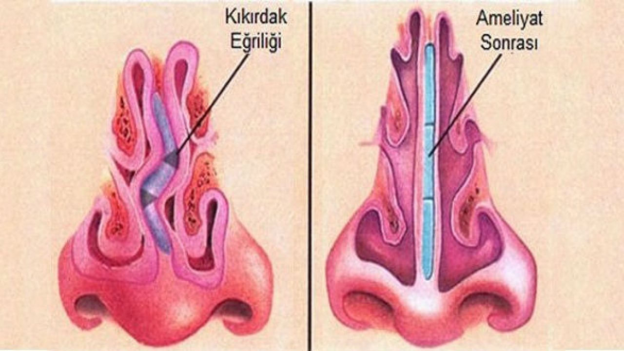 Vẹo vách ngăn mũi có cần phẫu thuật? Giải đáp từ bác sĩ