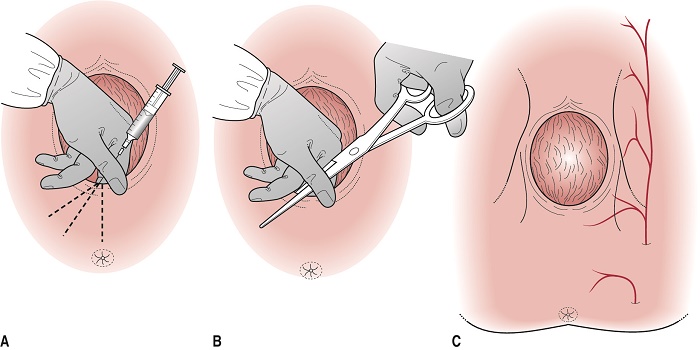 Vết rạch tầng sinh môn bị lồi có sao không?