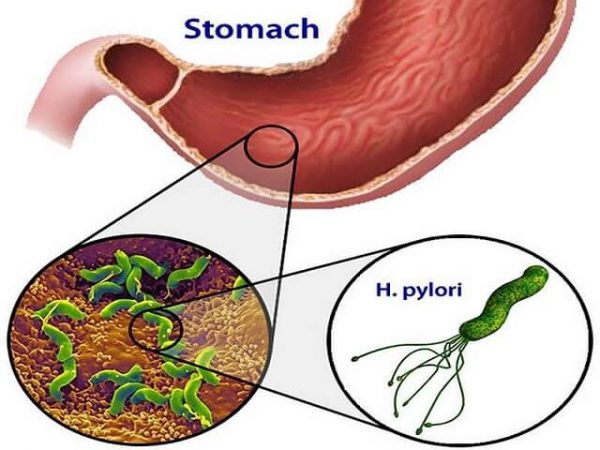 Vi khuẩn HP có chữa được không?