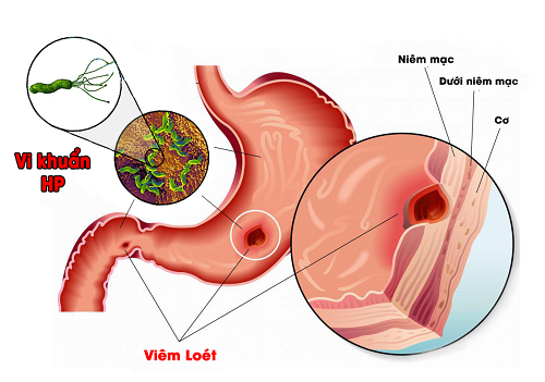 Vi khuẩn HP có gây ung thư không?