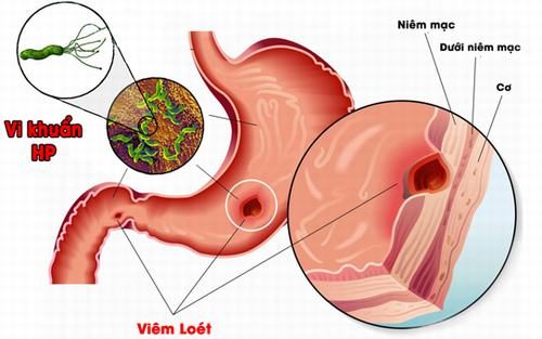 Vi khuẩn HP gây ung thư dạ dày