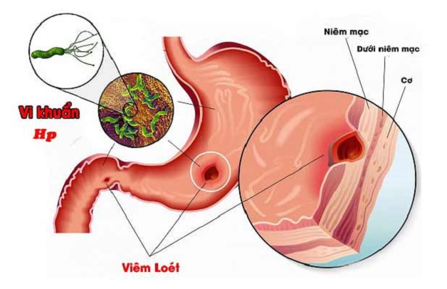 Vi khuẩn hp là gì? Cần làm gì khi nhiễm khuẩn HP
