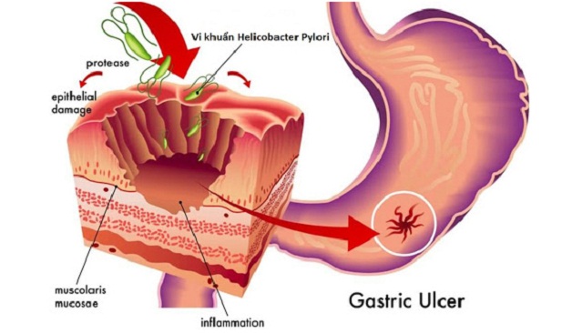 Vi khuẩn Hp từ đâu mà có, gây bệnh gì và cách phòng tránh