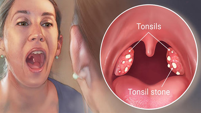 Vì sao bị sỏi amidan gây hôi miệng?