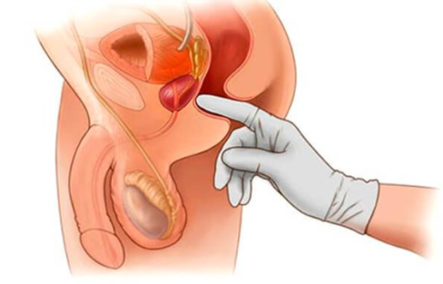 Vì sao cần tầm soát ung thư tuyến tiền liệt?