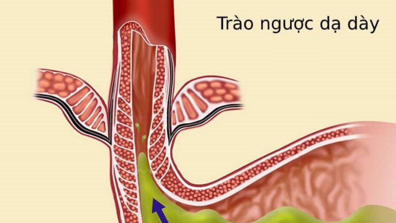 Vì sao lại bị trào ngược dạ dày: Giải đáp thắc mắc