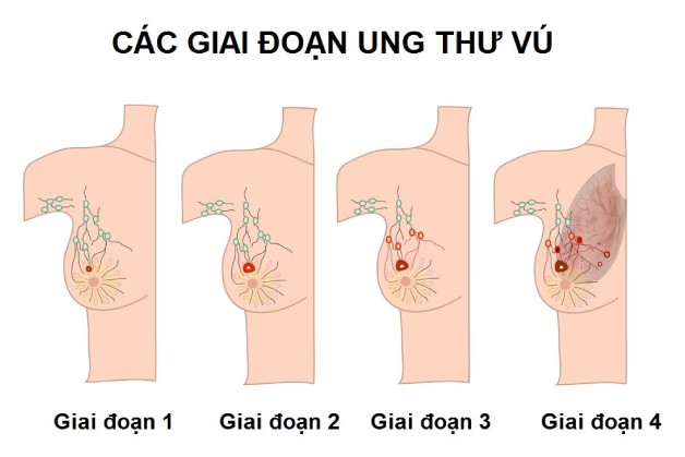 Vì sao tầm soát ung thư vú ở nữ giới quan trọng hơn nam giới