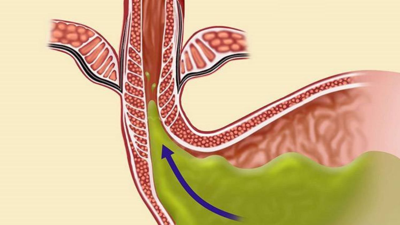 Vì sao trào ngược dạ dày xảy ra và những biến chứng