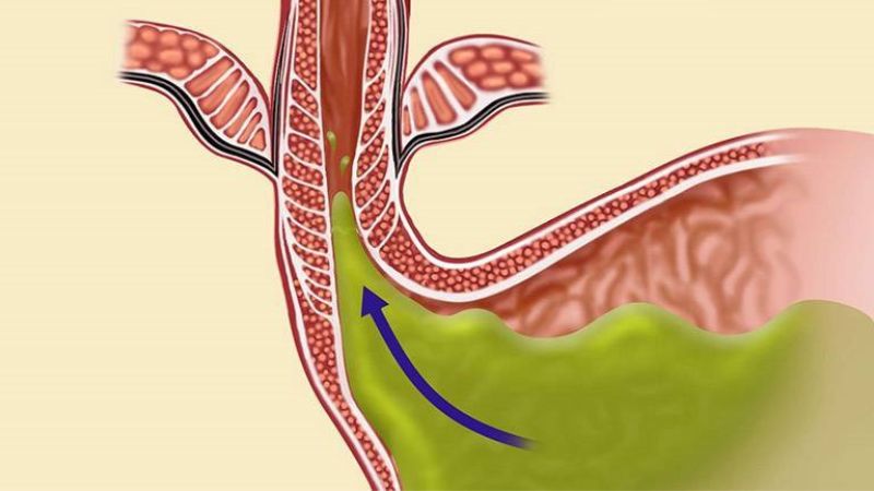 Vì sao trào ngược dạ dày xảy ra và những biến chứng