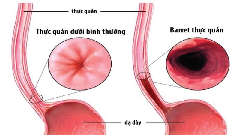 Vì sao trào ngược dạ dày xảy ra và những biến chứng