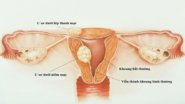 Vì sao u xơ tử cung gây rong kinh? Cách điều trị ra sao?