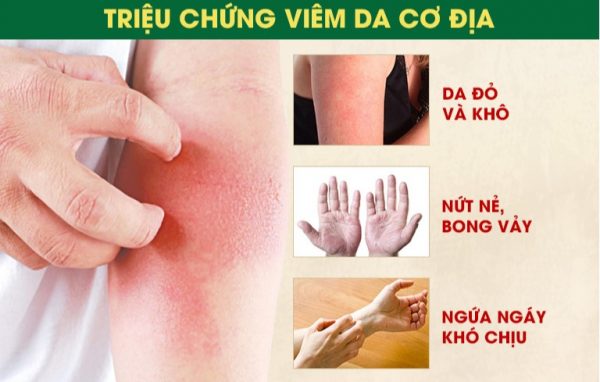 Vì sao viêm da cơ địa dễ tái phát khi trời lạnh?