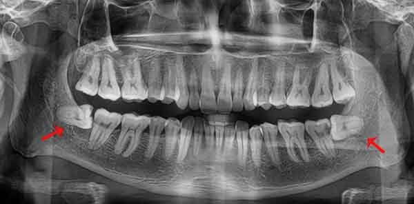 Vị trí răng số 8 ở đâu? Khi nào nên nhổ răng số 8?