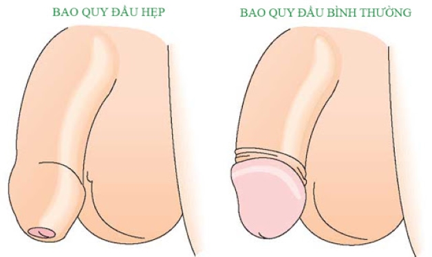 Việc cắt bao quy đầu có nguy hiểm không?