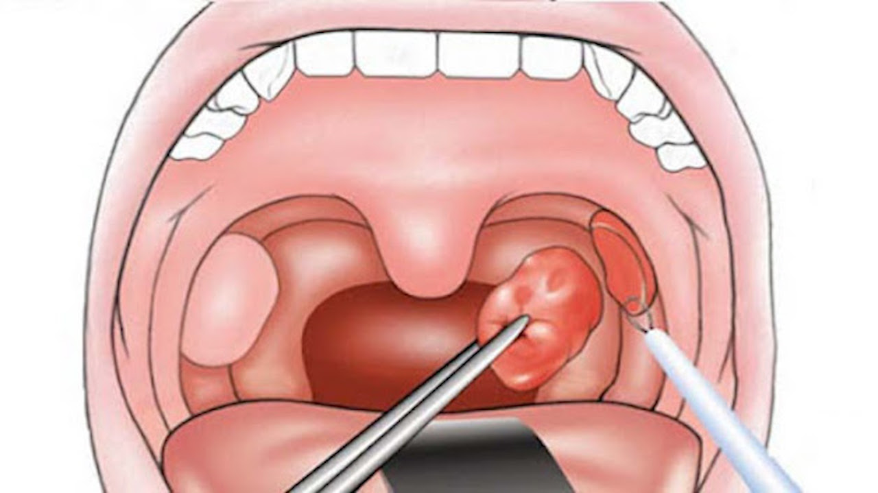 Viêm amidan là gì? Khi nào cần cắt amidan?