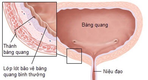 Viêm bàng quang có nguy hiểm không?