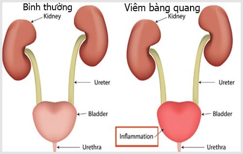 Viêm bàng quang nên ăn gì?điều trị viêm bàng quang