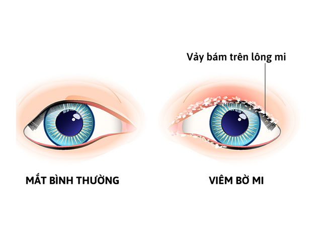 Viêm bờ mi có lây không? Điều trị như thế nào?