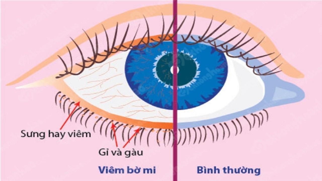 Viêm bờ mi là gì? Nguyên nhân và cách điều trị